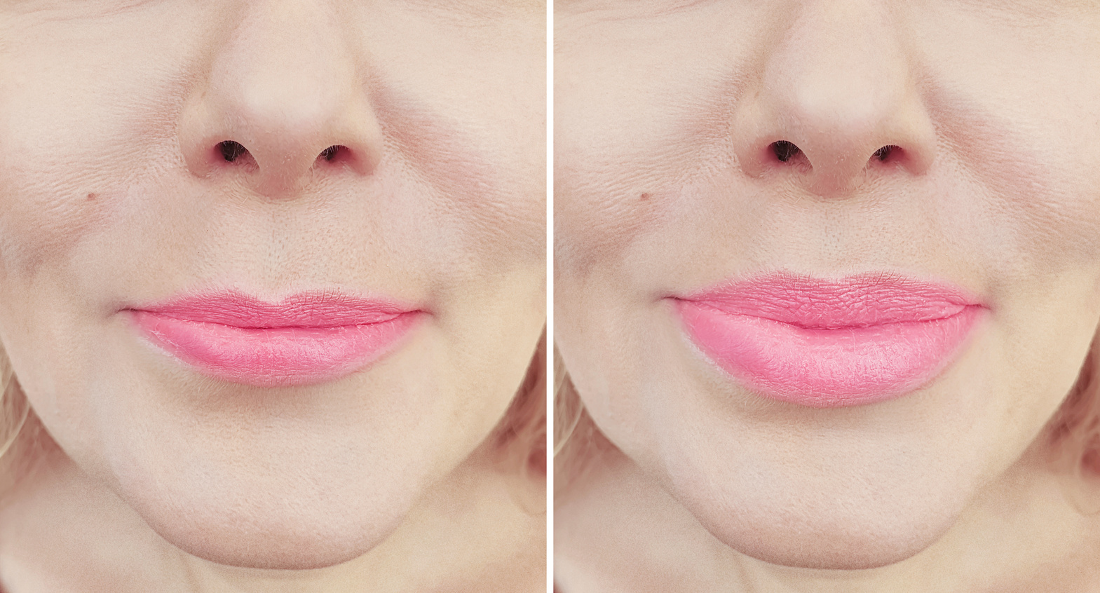 girl lips before and after augmentation
