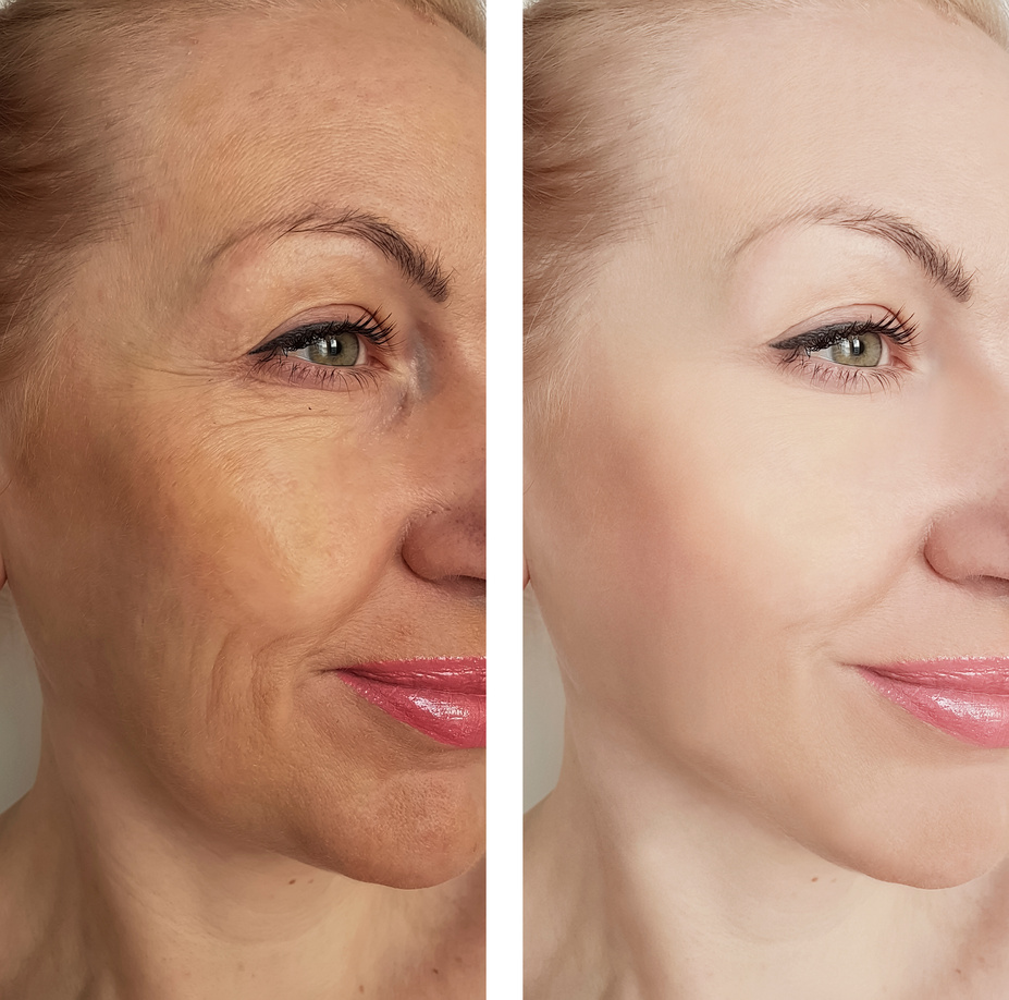 woman wrinkles before and after treatments