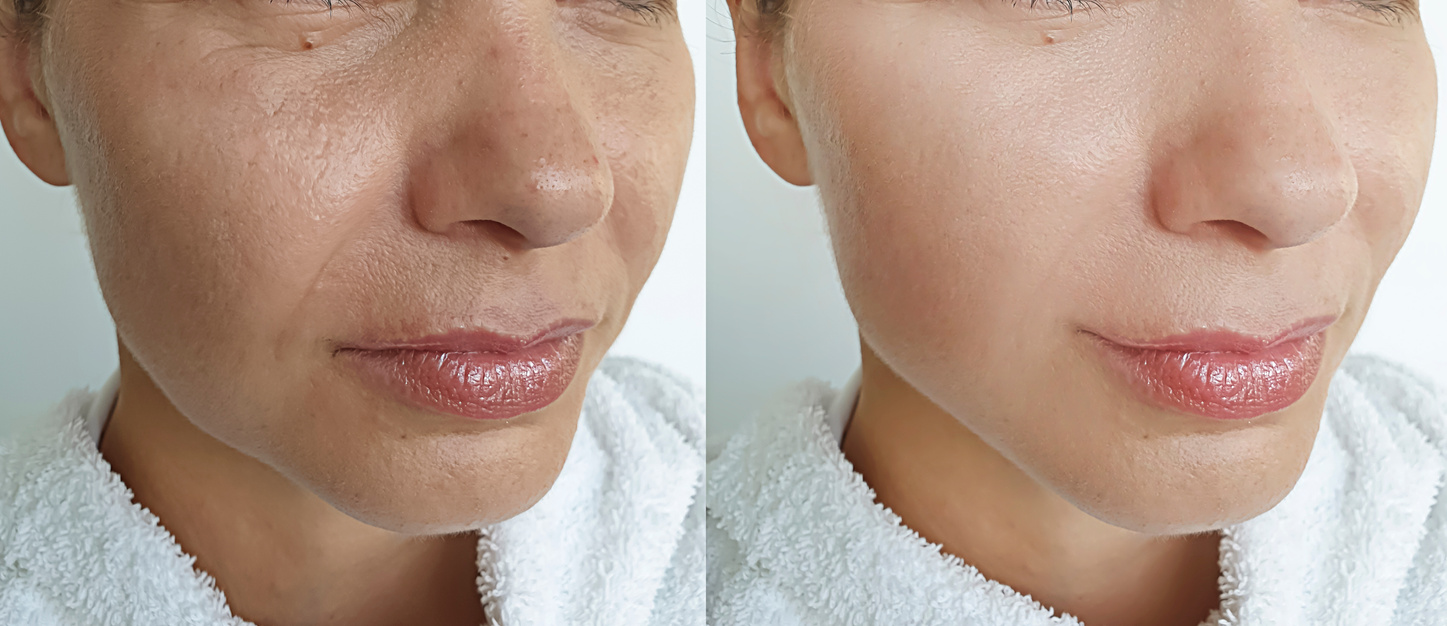 woman face wrinkles before and after treatment