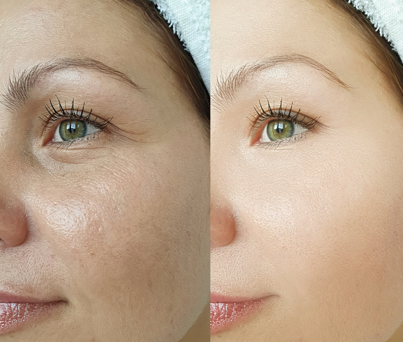 woman face wrinkles before and after treatment