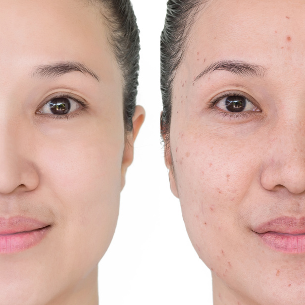Before and after Laser Treatment